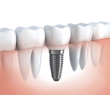 Dental Implant/Dental Treatment