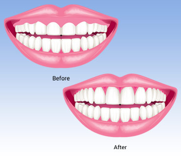 Gum Depigmentation & Contouring