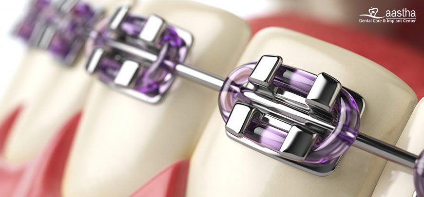 Orthodontic/Braces Treatment