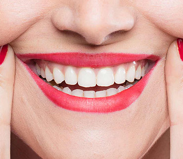 Smile Makeover with Veneers